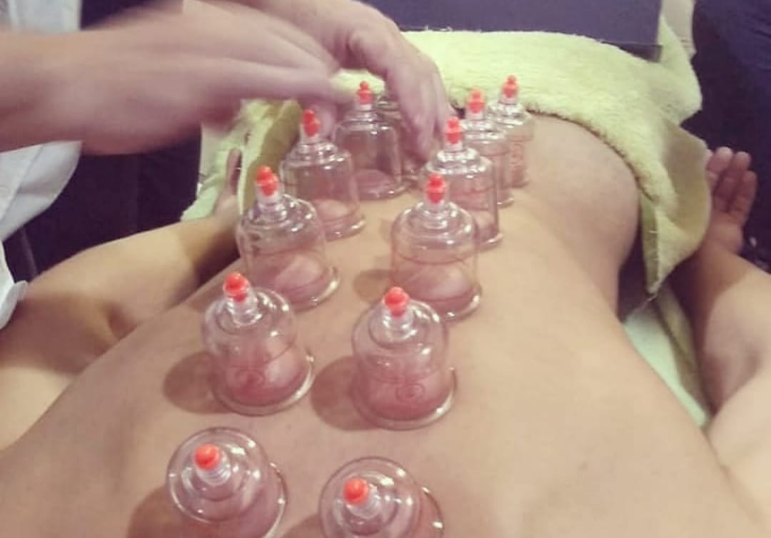 Terapia com Ventosas